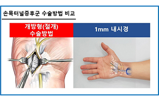 손목터널증후군 수술 병원 관절내시경 활용한다면